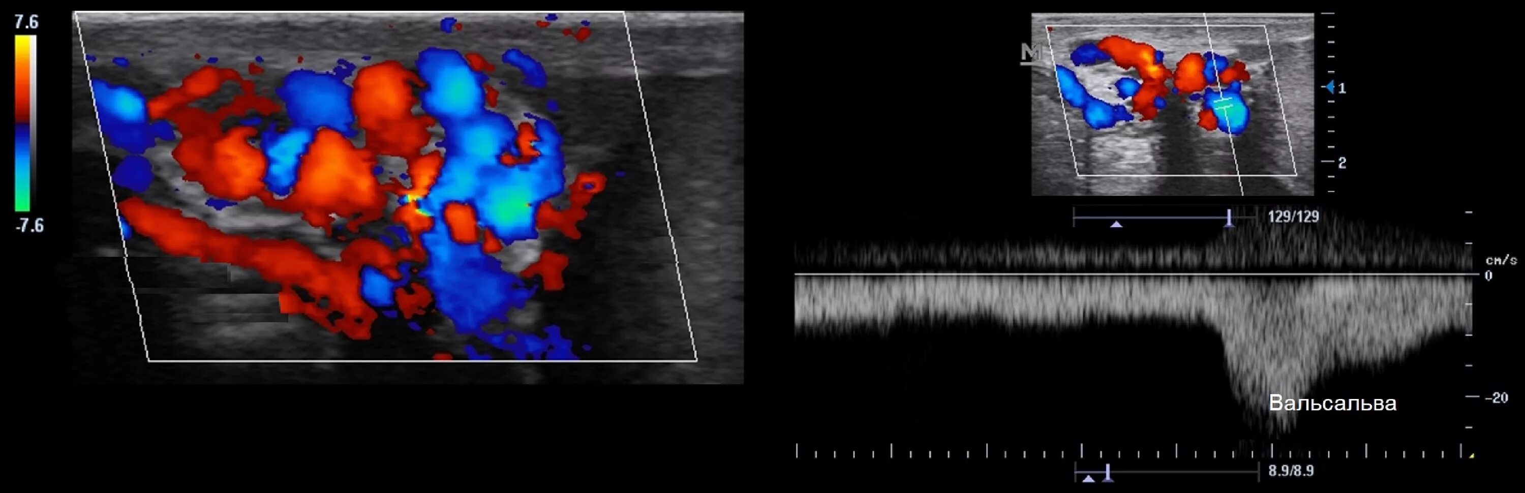 Расширение семенной вены. Вены семенного канатика на УЗИ. УЗИ сосудов семенного канатика. Проба Вальсальвы УЗИ вен. Норма вен семенного канатика по УЗИ.