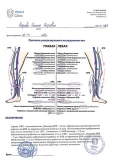Клапан бпв голени