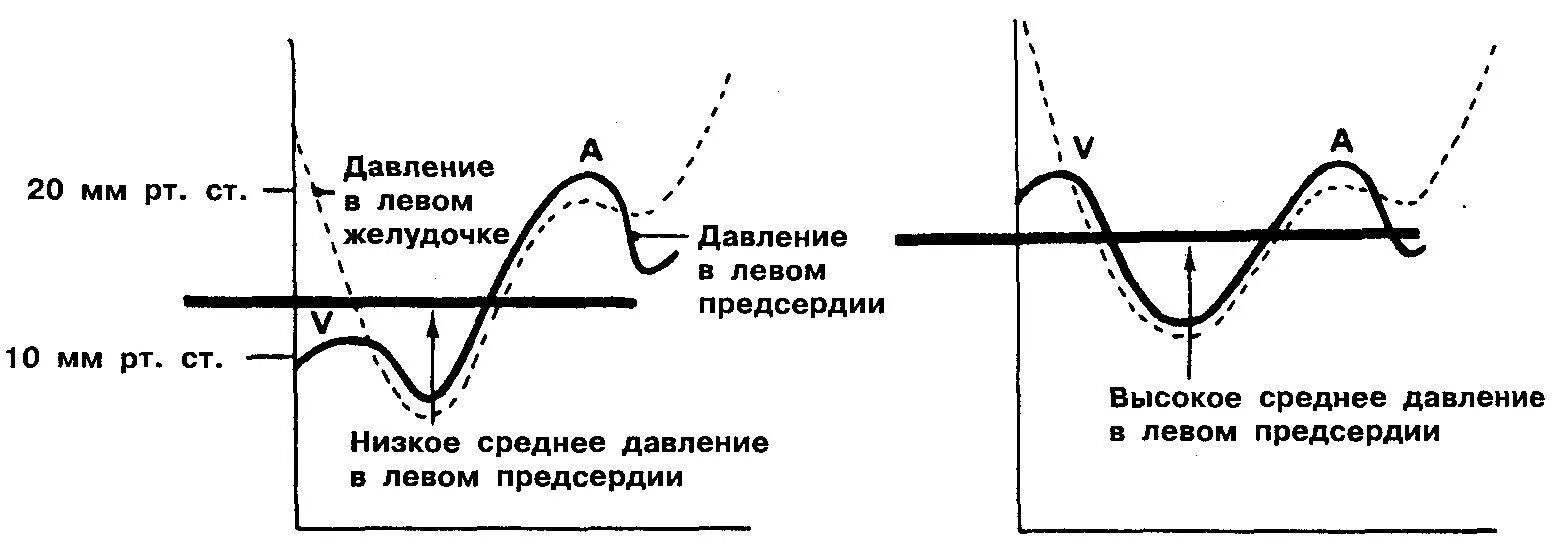 Давление в правом предсердии. Кривые давления в предсердиях. Кривая давления правого предсердия. Давление в левом желудочке. Кривая давления в правом предсердии.