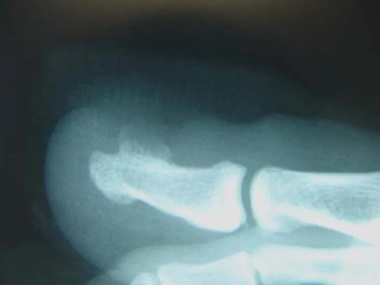 Ногтевая фаланга ноги. Экзостоз фаланги пальца на рентгене. Подногтевой экзостоз рентген. Остеома ногтевой фаланги 1 пальца стопы. Экзостоз фаланги стопы.
