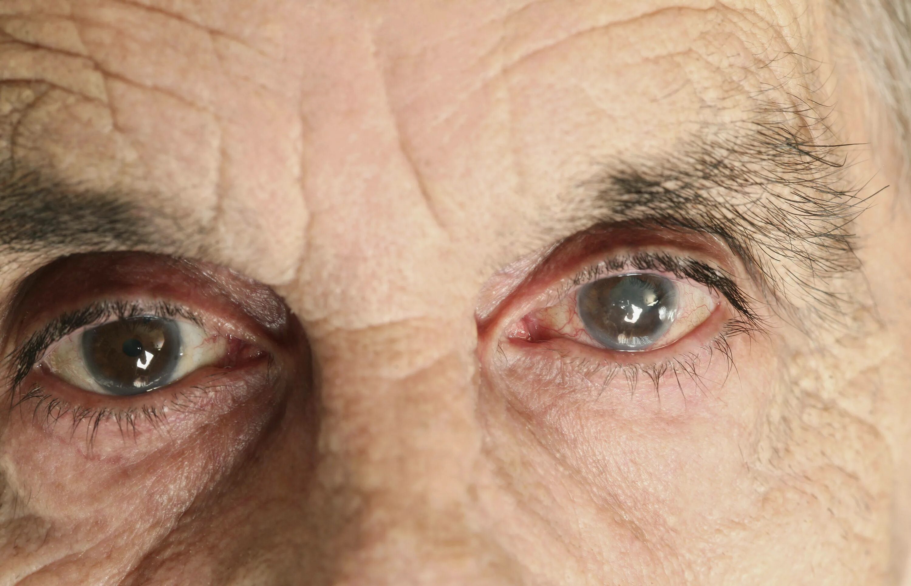 Сенильная катаракта глаза. Катаракта светобоязнь. Сенильная диабетическая катаракта. Болезнь глаз катаракта. Нарушение глаза