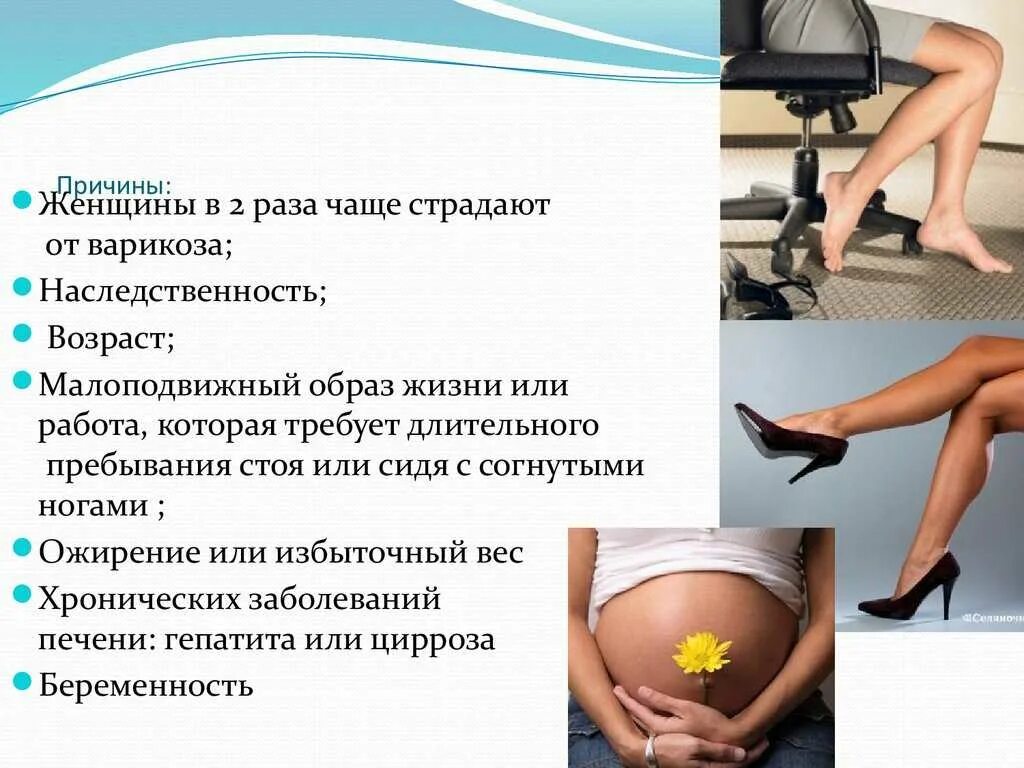 Отек ног при сидячей работе. Отекают ноги при сидячей работе. почему отекают ноги при сидячей работе. варикоз при беременности 2 триместр.