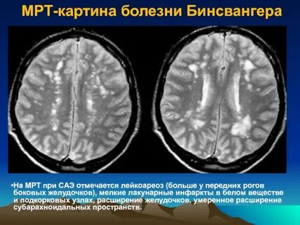 Сосудистые очаги