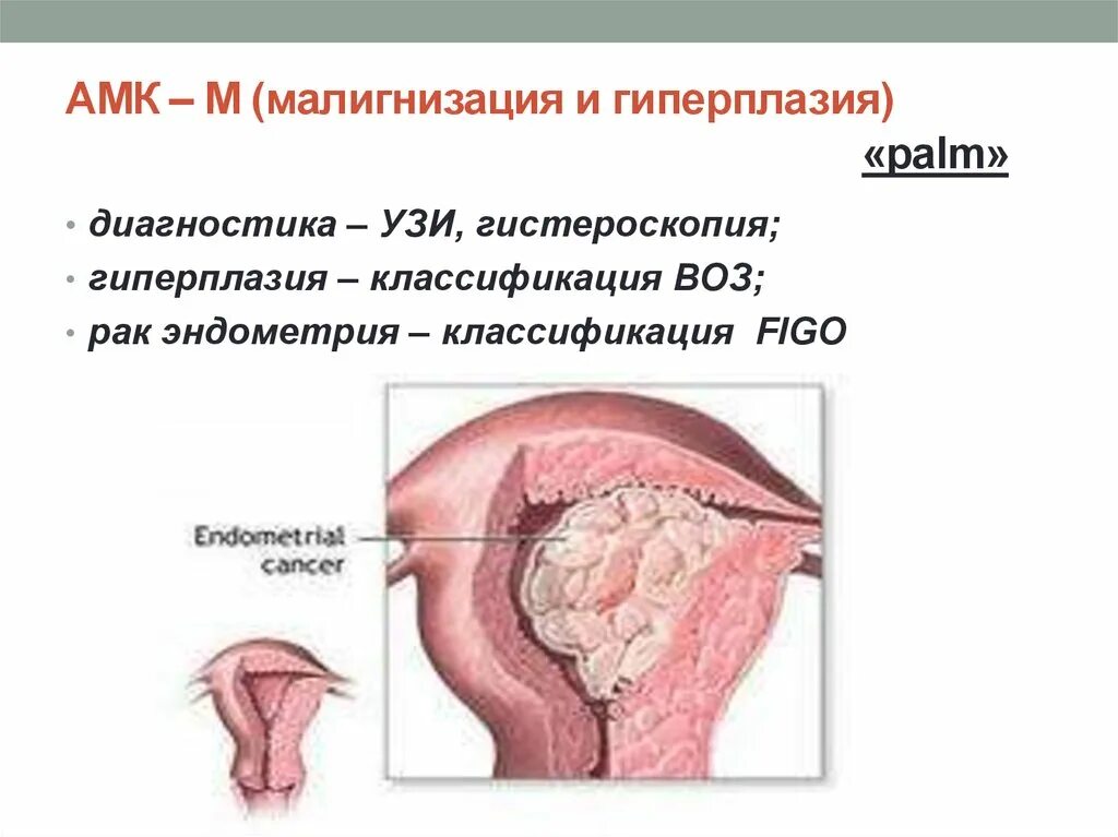 АМК гиперплазия эндометрия. Гиперплазия эндометрия гистероскопия. Ультраменструальная гиперплазия эндометрия что это. Эндометрия матки УЗИ гиперплазия эндометрия.