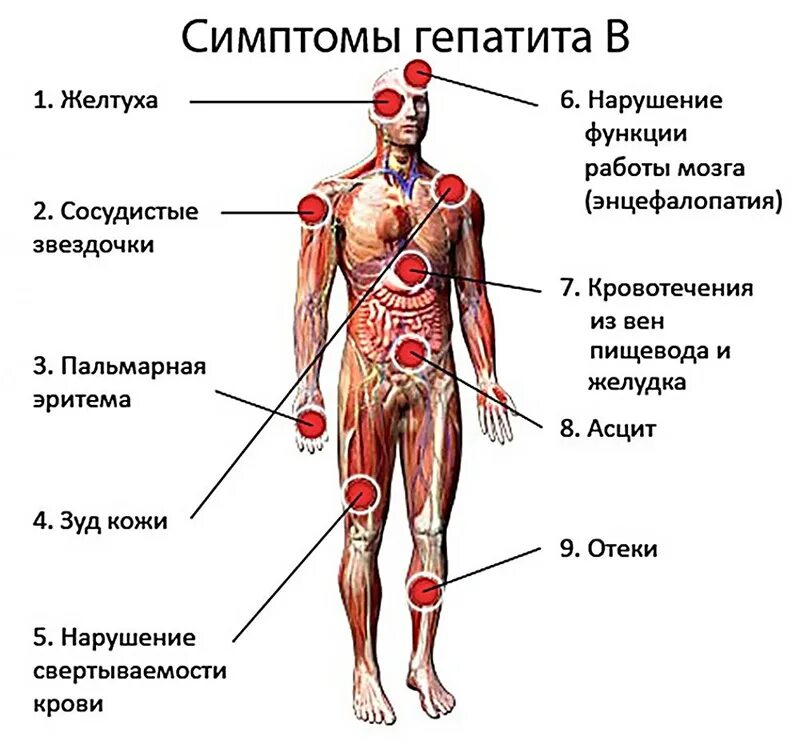 Признаки заболевания гепатитом. Клинические симптомы гепатита б. Вирусный гепатит симптомы. Симптомы гепатита в с симптомы.