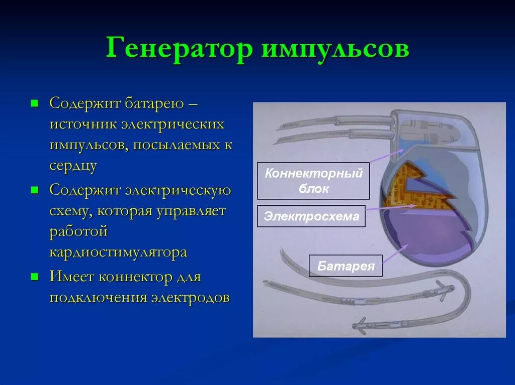 Кардиостимулятор схема. Схема работы кардиостимулятора. Строение электрокардиостимулятора. Схема установки кардиостимулятора.