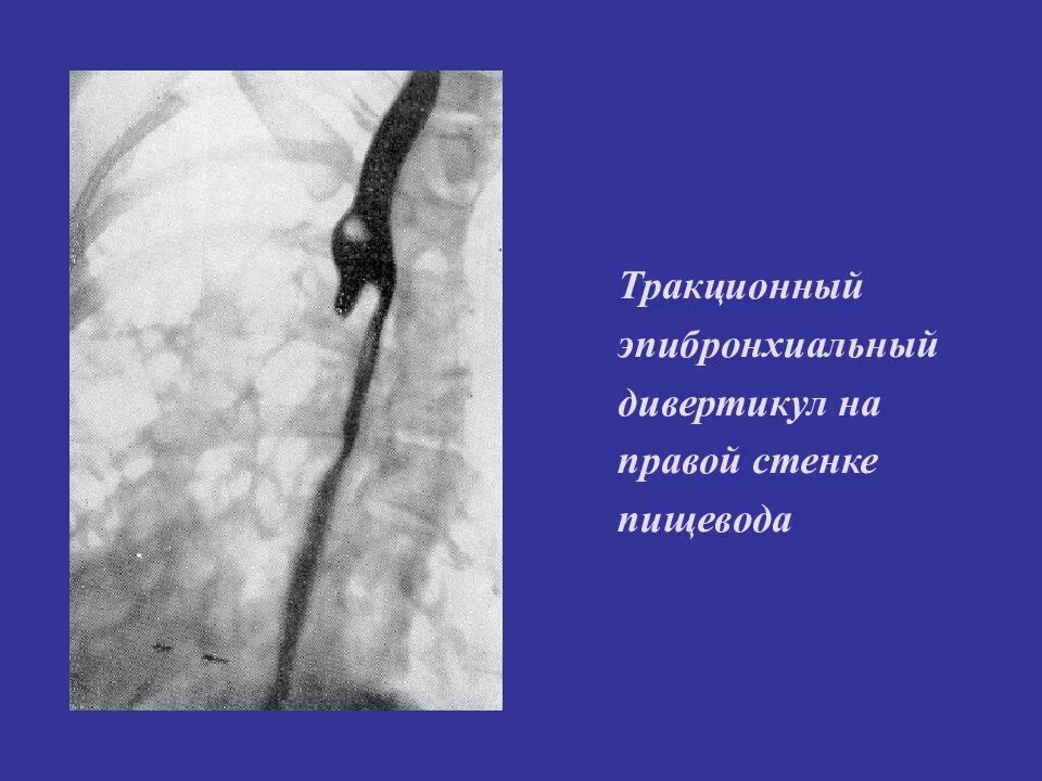 Лучевая пищевода. Тракционный дивертикул пищевода рентген. Эпифренальные дивертикулы пищевода. Эпибронхиальные дивертикулы это. Тракционные эпибронхиальные дивертикулы пищевода?.