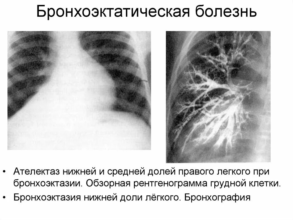 Бронхит бронхоэктатическая болезнь. Клинические симптомы бронхоэктатической болезни. Бронхоэктатическая болезнь бронхография. Бронхоэктатическая болезнь основные клинические проявления. ФБС бронхоэктатическая болезнь.