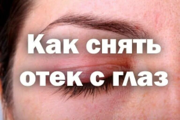 Как убрать сильный отек. Какиснять отесеость с глаз. Как убрать отёки с глаз быстро. Как быстро убрать отёк с глаз.