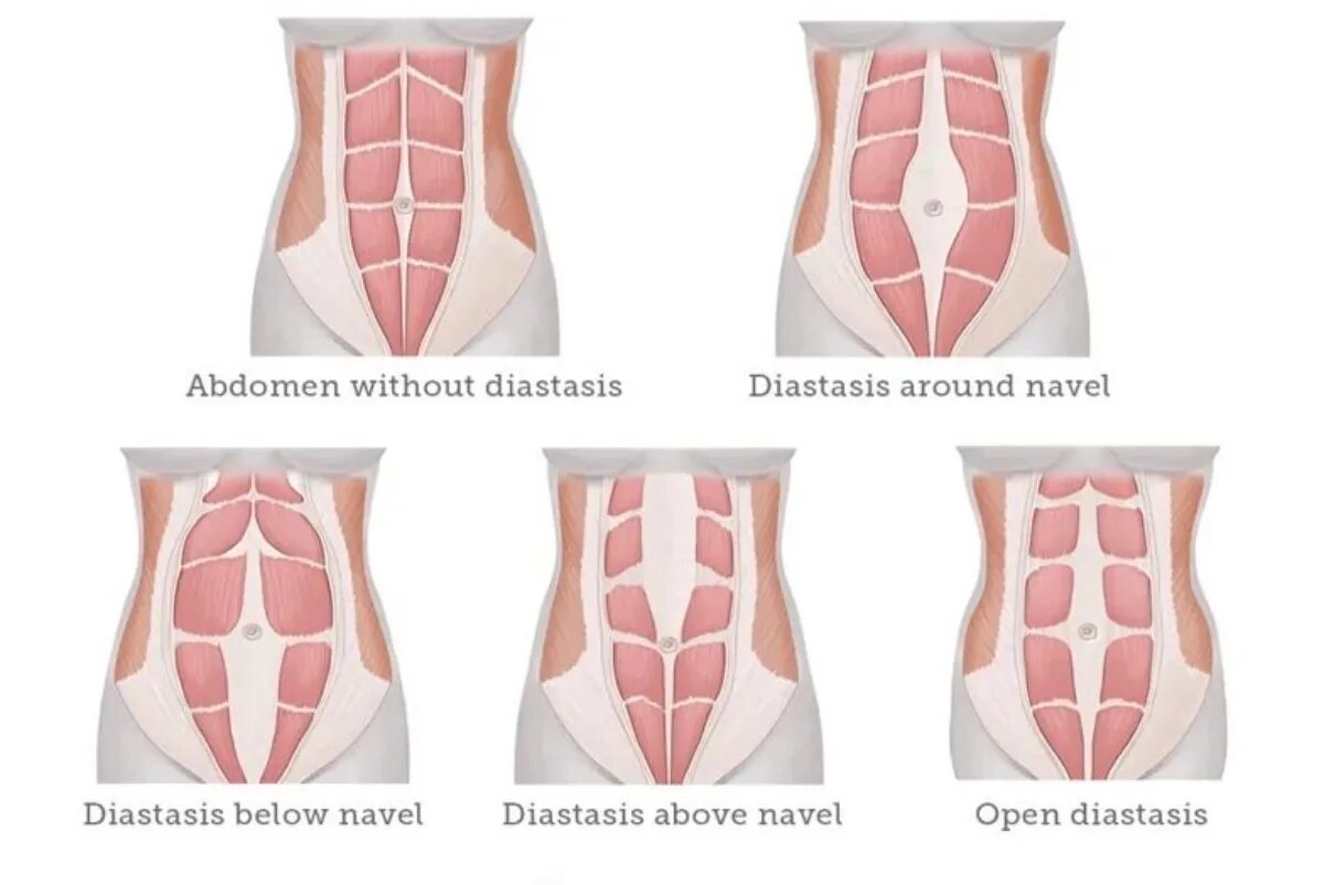 Прямая мышца живота у женщин. Диастаз брюшной стенки. Мышцы живота анатомия диастаз. Диастаз прямой мышцы беременность.