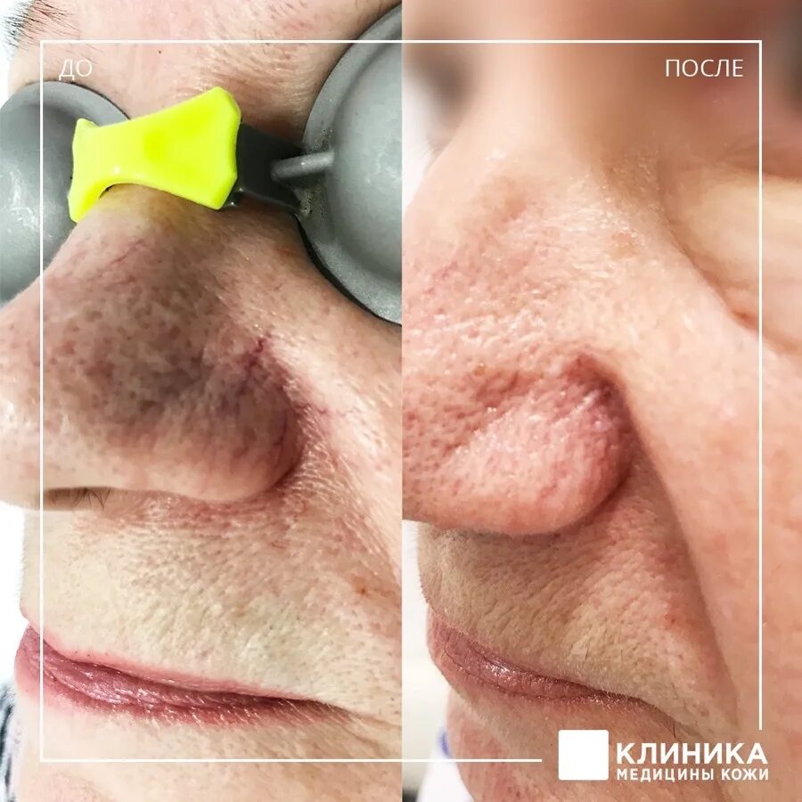 Лечение купероза лазером