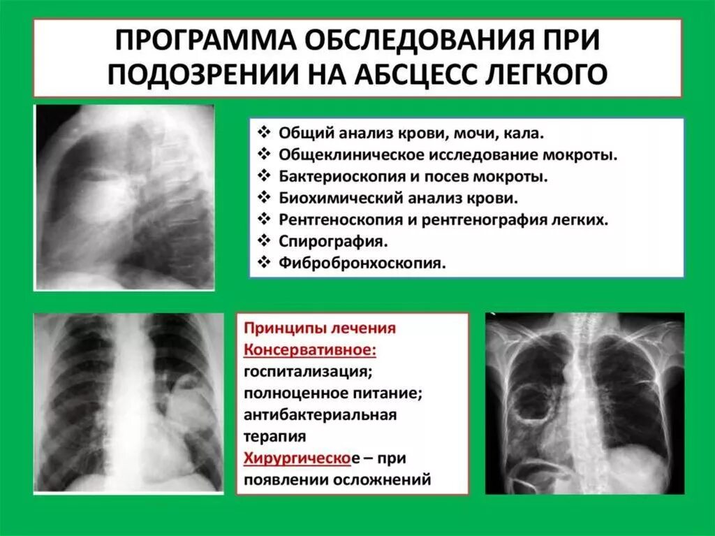 Диагноз абсцесс легкого. Методы обследования абсцесса легкого. Абсцесс легкого план обследования. Методыдиагностики абцесс легкого. Исследования при абсцессе легкого.