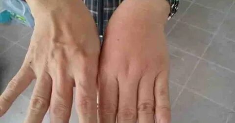 Отек рук по утрам причины у женщин