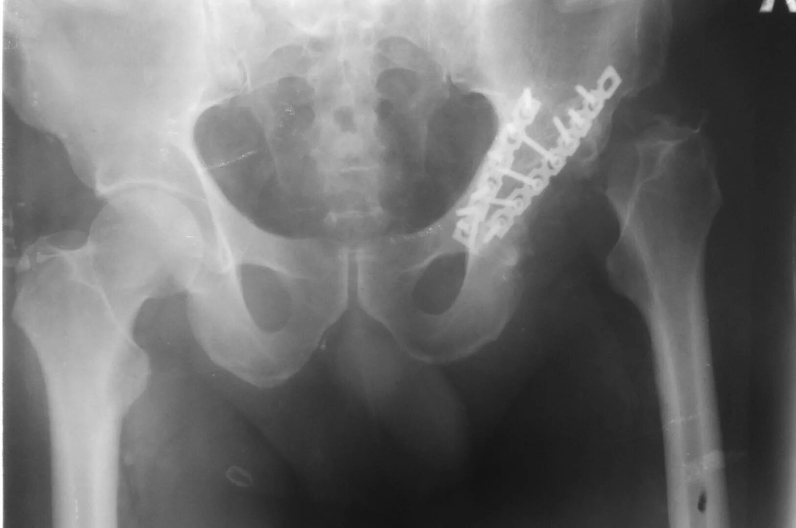Вывих тазобедренного протеза. Вывих тазобедренного протеза. Эндопротез тазобедренного сустава нестабильность рентген. Эндопротез эскулап рентген. Эндопротез тазобедренного сустава irene.