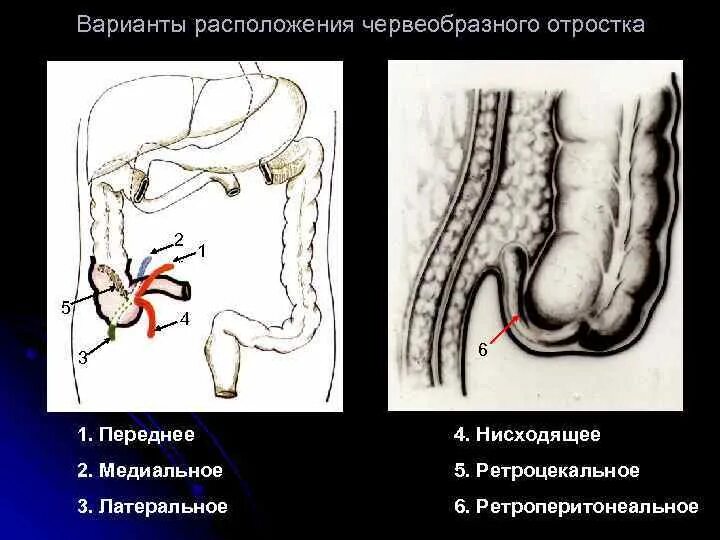 Аппендикс червеобразный. Ретроцекальный аппендицит расположение. Ретроцекальное ретроперитонеальное расположение аппендикса. Острый аппендицит ретроцекальное расположение. Ретроцекальное расположение аппендицита.