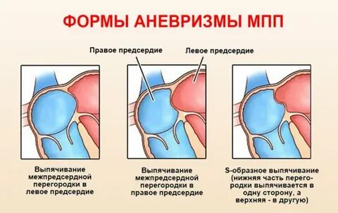 Аневризма сердца диагностика