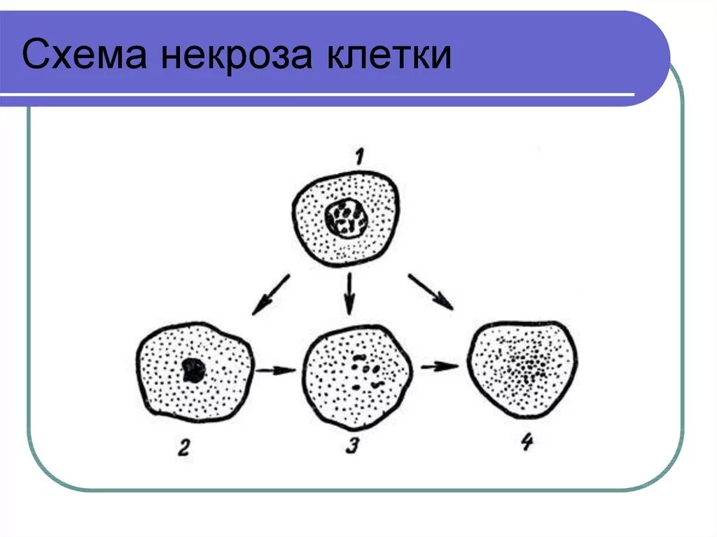 Микроскопические изменения в клетках. Некроз клетки схема. Стадии некроза ядра клетки. Апоптоз и некроз схема. Некроз клетки цитология.