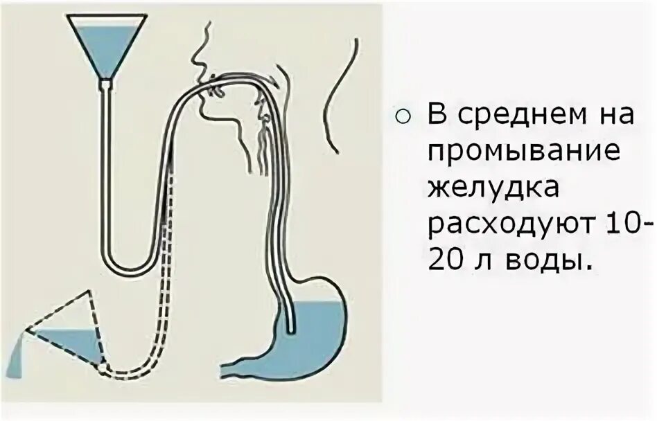 Промывание желудка у детей алгоритм. Промывание желудка зондовым методом алгоритм. Периодизация острых отравлений у детей. Алгоритм промывания желудка пациенту. Количество жидкости необходимой для промывания желудка.