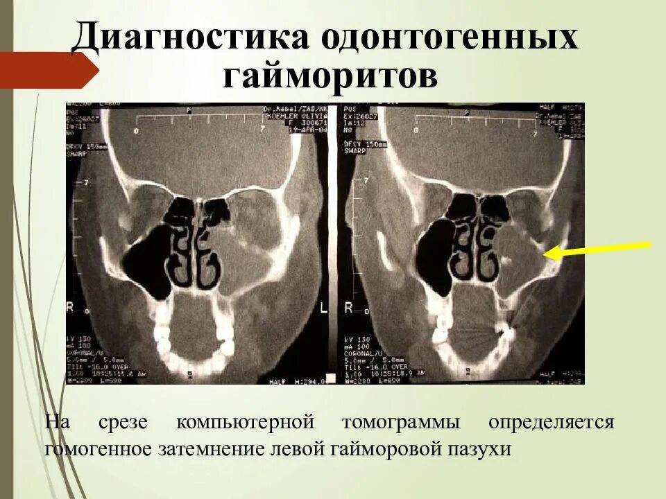 Гайморит диагностика