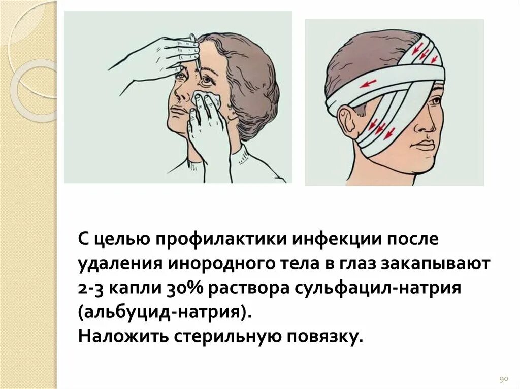 После удаления инородного тела закапать в глаз. Инородное тело профилактика. Инородное тело в глазу капли. Стерильная повязка на глаз. Помощь при инородном теле в глазу