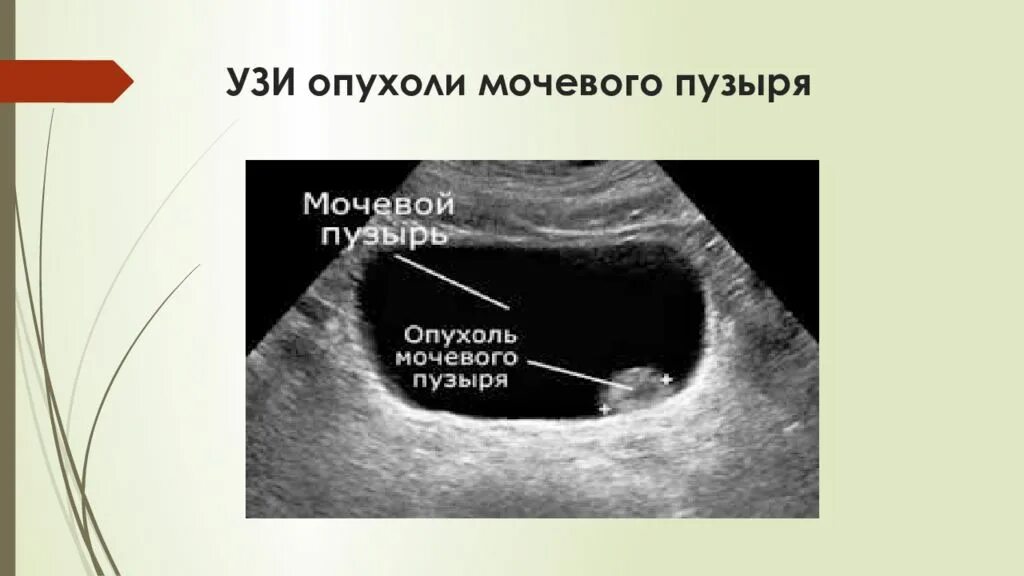 Полип мочевого пузыря на УЗИ. Объемное образование мочевого пузыря на УЗИ. Опухоль мочевого пузыря УЗИ. Новообразование мочевого пузыря на УЗИ. Рак мочевого отзывы