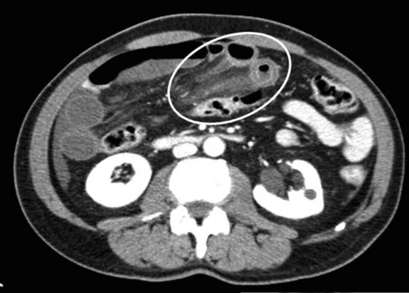 Инфильтрация брыжейки на кт. Тромбоз сосудов брыжейки на кт. Туберкулез кишечника кт. Кт кишечная непроходимость мезентериальный тромбоз. Тромбоз на кт