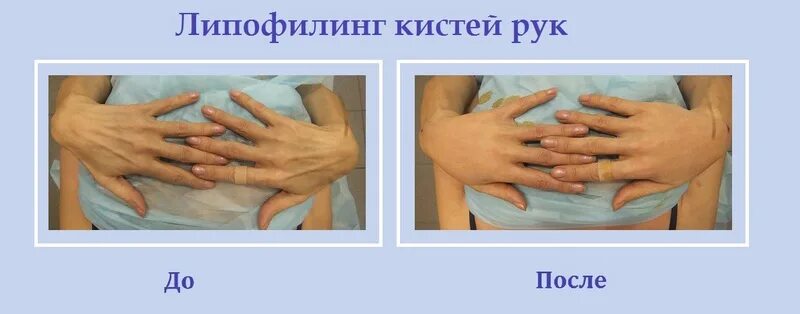 Увеличение груди до и после. Липофилинг молочной железы. Липофилинг грудных. Липофилинг молочных желёз. Липофилинг грудных.