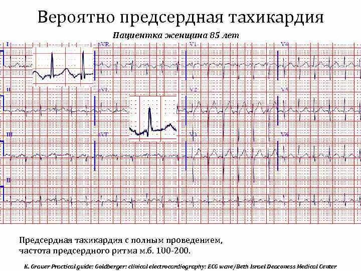 Предсердная блокада на экг. Многофокусная предсердная тахикардия на экг. многоочаговая предсердная тахикардия на экг. предсердная тахикардия с ав блокадой на экг. предсердная тахикардия с ав блокадой 2.