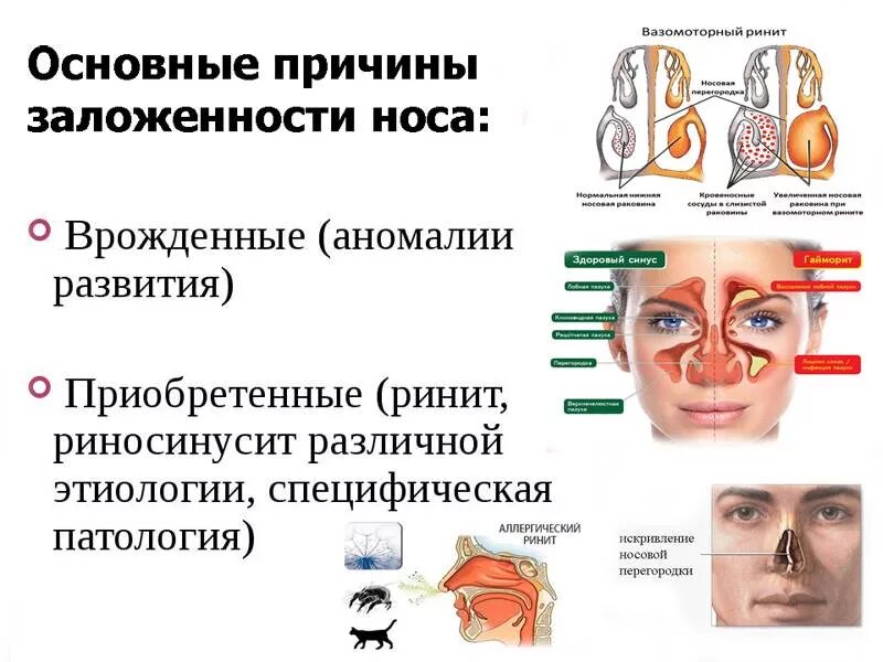 Греть ли нос при заложенности носа. Почепочему закладывает нос. Причины заложенности носа.