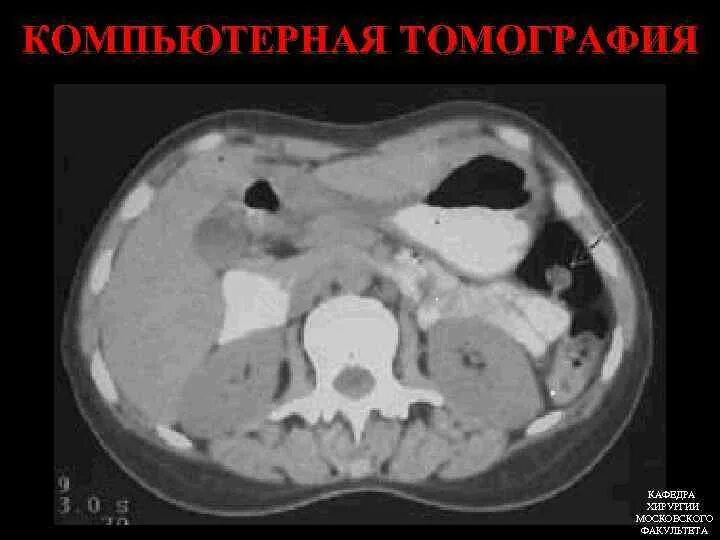 Опухоль ободочной кишки на кт. Опухоль сигмовидной кишки на кт. Полипы толстой кишки кт. Опухоль толстой кишки на кт. На кт видно опухоль