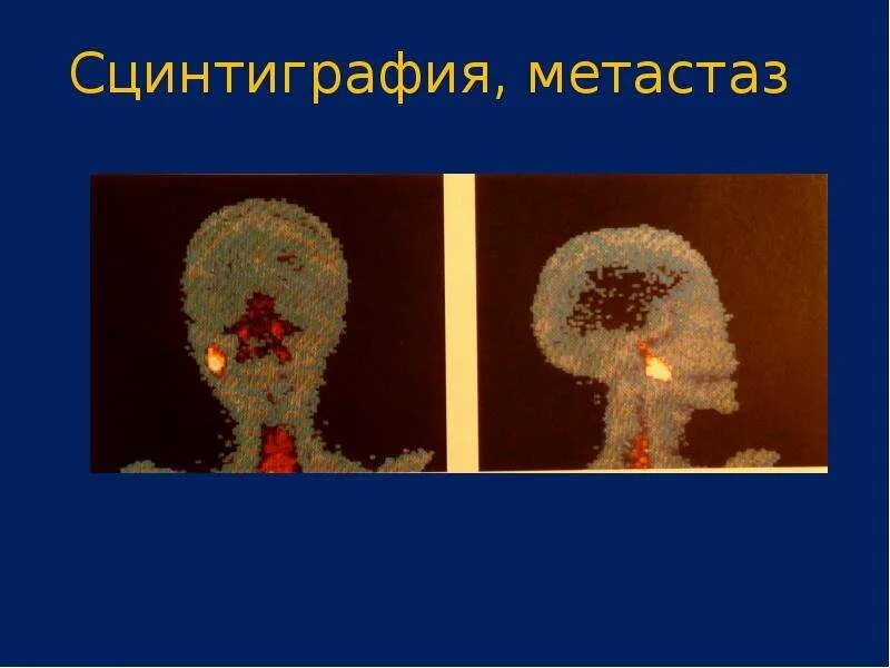 Статическая сцинтиграфия скелета. Сцинтиграфия метастазы в костях. Сцинтиграфия скелета метастазы. Сцинтиграфия скелета норма. Сцинтиграфия скелета метастазы.