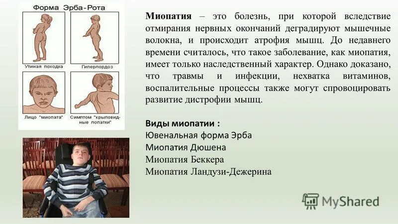 Миопатия что это за болезнь. Мышечная миопатия Дюшенна. Прогрессирующие миопатии. Мышечная дистрофия миопатия.