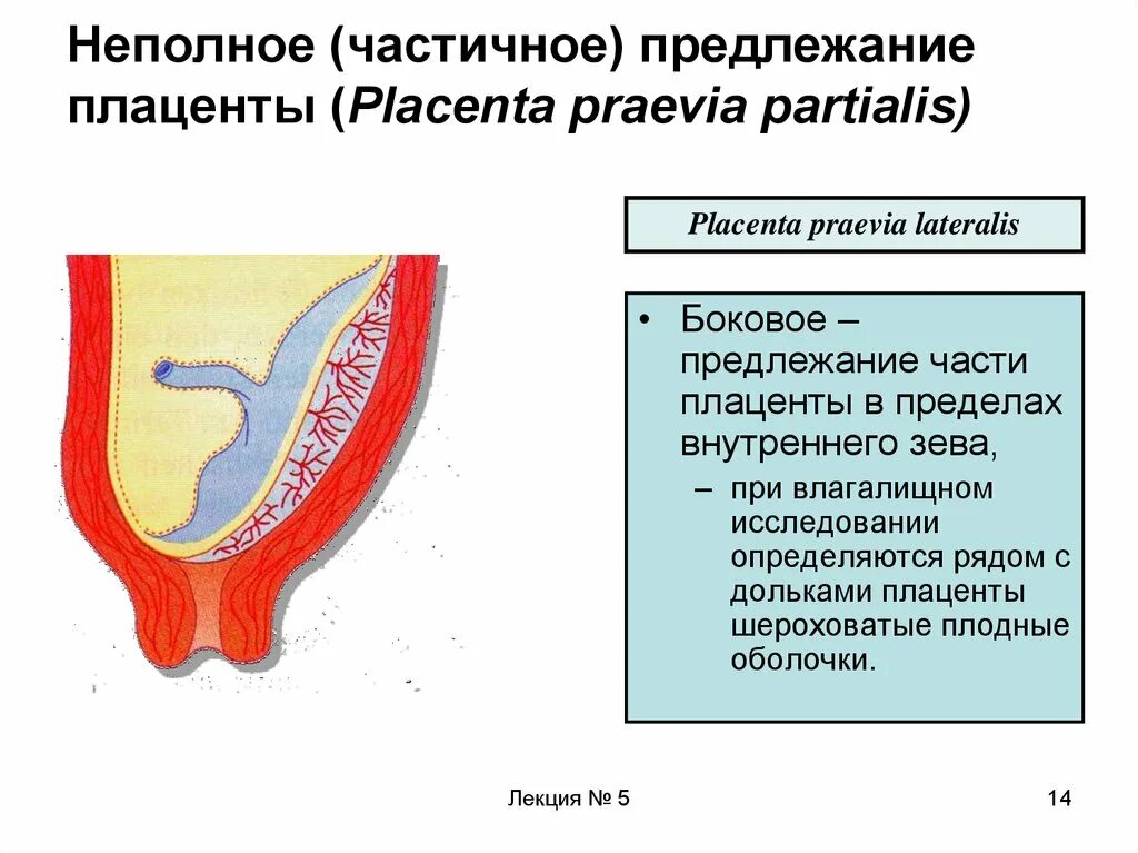 Полное предлежание форум. Плодовый фактор предлежания плаценты. Предлежание плаценты влагалищное обследование. Неполное предлежание плаценты. Частичное предлежание плаценты.