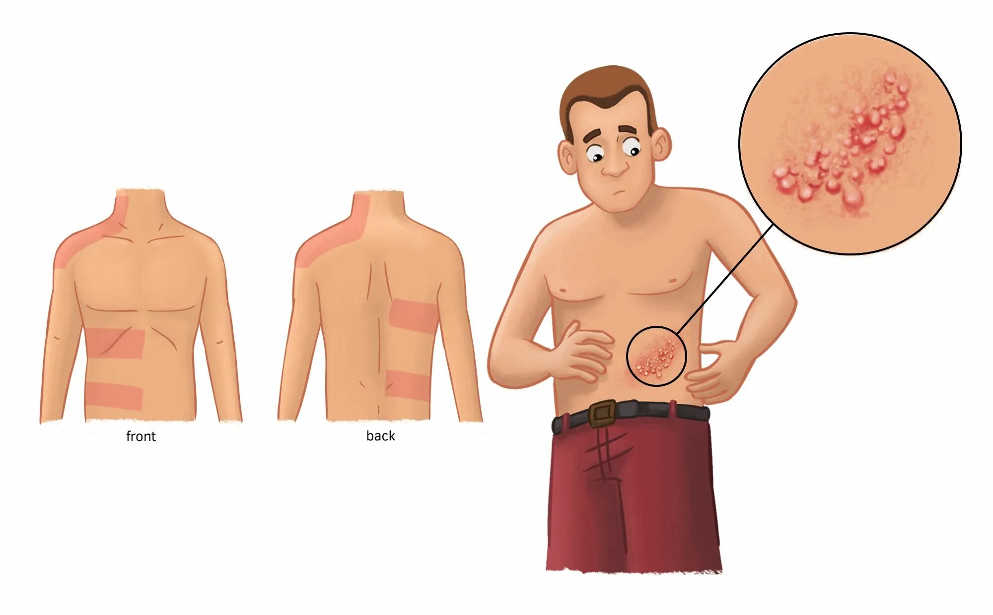 герпес у пожилых людей. опоясывающий лишай специфическая профилактика. обработка опоясывающего герпеса. лекарства при герпес зостер. профилактика опоясывающего герпеса.