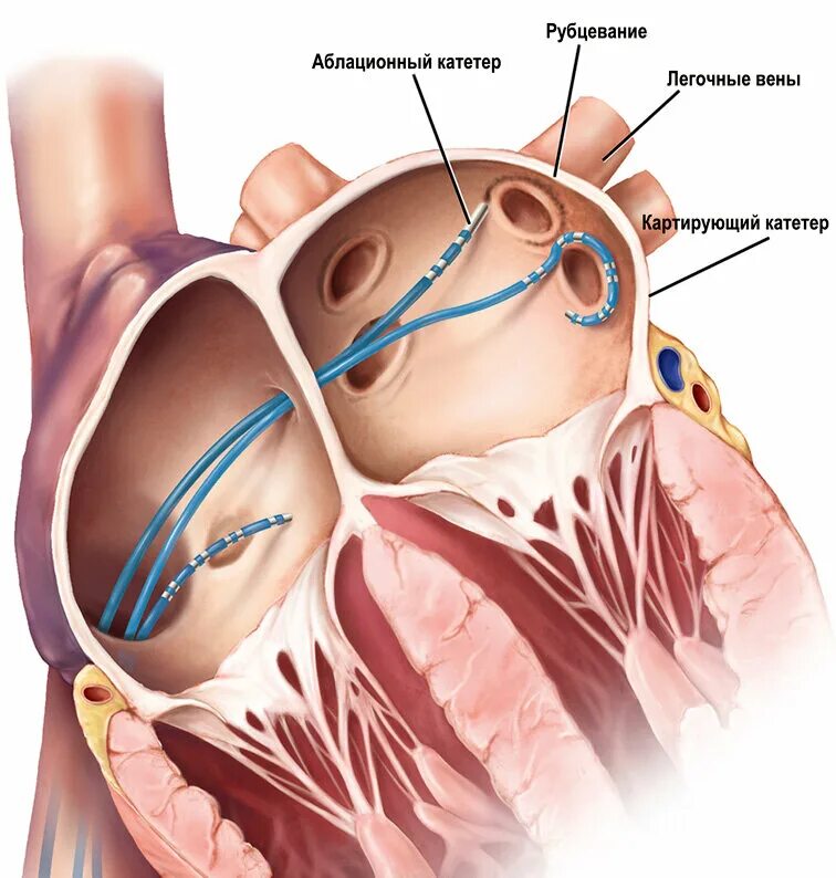 Рча предсердий. Радиочастотная абляция сердца. Предсердий катетерная абляция. Высокочастотная абляция сердца. Абляция фибрилляции предсердий.