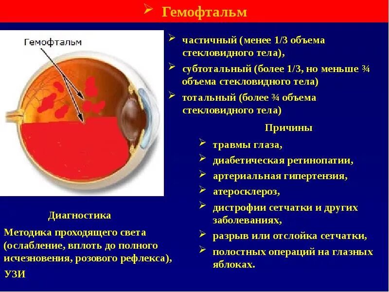 Гемофтальм мкб 10. Травматический гемофтальм. Кровоизлияние в стекловидном теле.