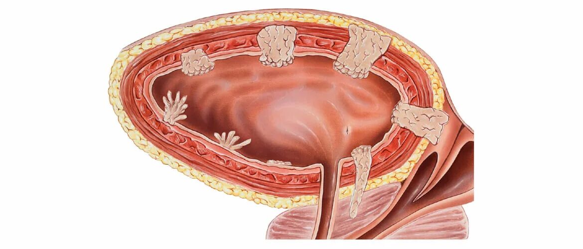 Злокачественная опухоль мочевого пузыря. Раковая опухоль мочевого пузыря. Доброкачественная опухоль мочевого пузыря. Опухоли мочевого пузыря классификация.