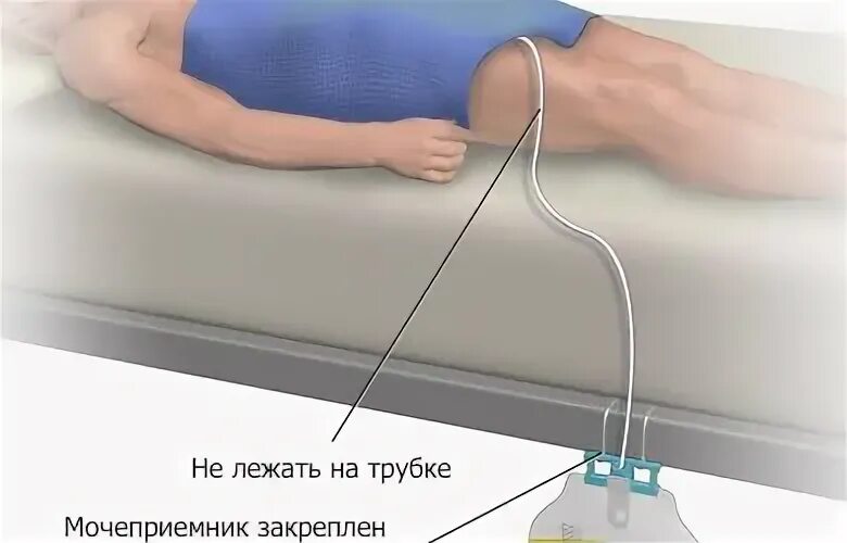 Болит дренаж. Моче приёмник к катетер фолея. дренажная система мочевого пузыря. катетер для лежачих мужской. катетер для отвода мочи женский.
