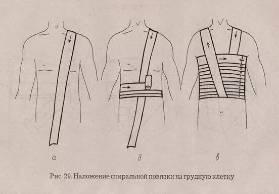 Повязка на грудную клетку алгоритм. Спиральная повязка на грудную клетку с портупеей. Наложение спиральной повязки на грудную клетку. Спиральная перевязка грудной клетки. Перевязка при переломе ребер.