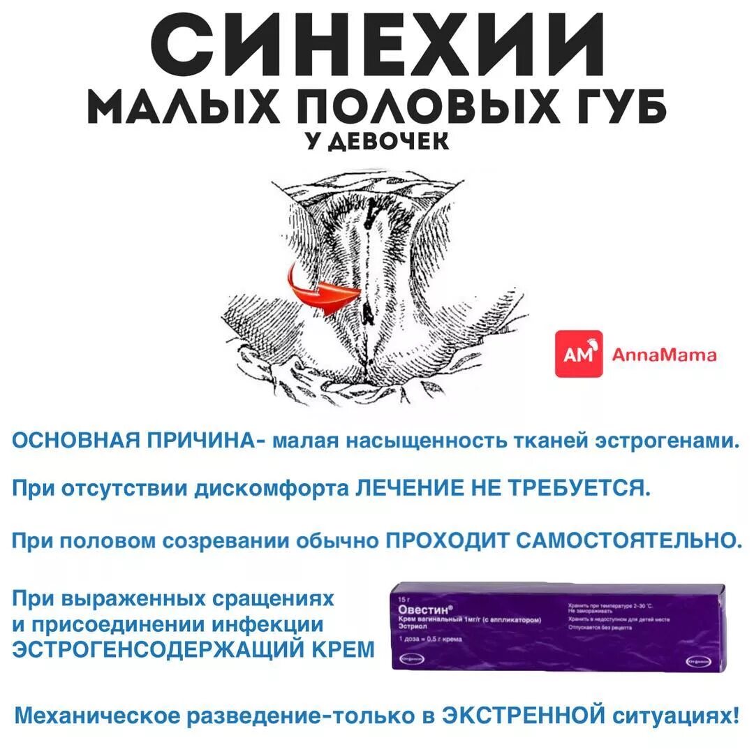 Синехия мазь овестин. Сращивание половых губ у малышей. Овестин при синехиях у девочек. Синехии у девочек новорождённых. Синехии малых губ у девочки.