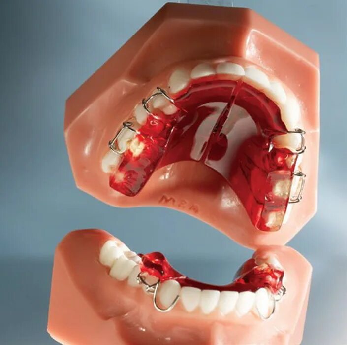 ппарат твин-блок ларка. Twin block. Twin block. Двухчелюстной аппарат твин блок. Ортодонтический аппарат твин блок (twin block).