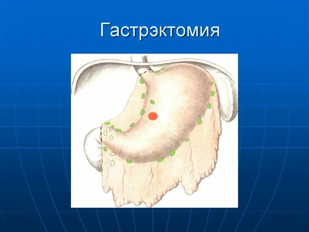 Удаление желудка полностью при раке. Гастроэктомия желудка операция ход операции. тотальная гастрэктомия желудка. гастрэктомия резекция желудка. комбинированная гастрэктомия.