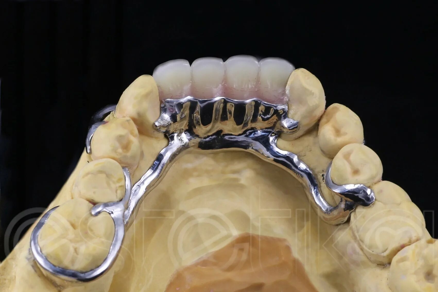 бюгельный протез с кламмером джексона. бюгельные протезы класса. 4 класс по кеннеди бюгельный протез. 07. базис бюгельного протеза.