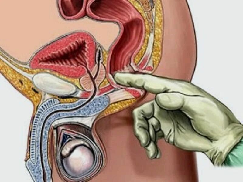 Простата хочет. Пальцевое ректальное исследование прямой кишки. Пальцевое ректальное исследование простаты. Пальцевое исследование прямой кишки и предстательной железы. Пальцевое ректальное исследование железы.