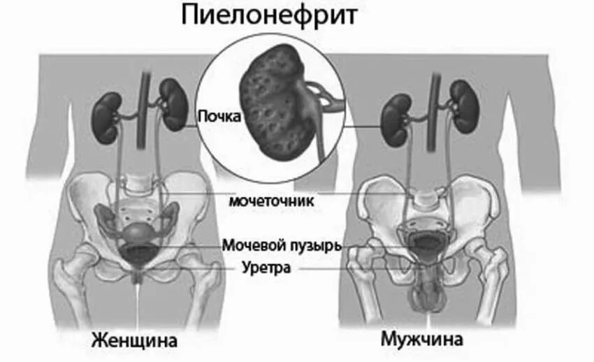 Воспаление мочеточника у женщин. Воспаление мочеточника у женщин. Полинифрит почек у женщин. Воспаление мочеточника у женщин. Мочекаменная болезнь мочеточника.