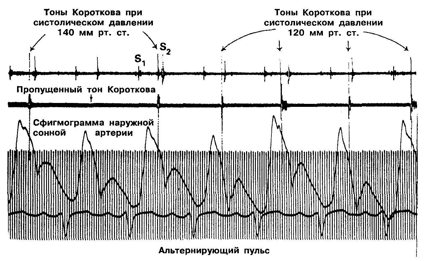 Брадикардия какое давление