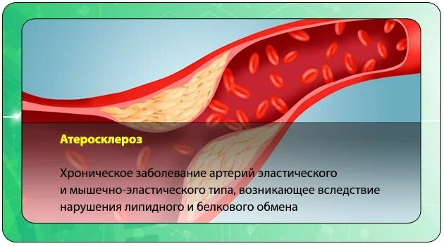 Атеросклеротическим поражением магистральных артерий. Атеросклероз заболевание артерий эластического. атеросклероз картинки для презентации. атеросклероз рисунок для презентации. атеросклеротическая болезнь сердца 125.1.