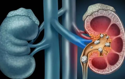 Diagnosed prevalent cases of chronic kidney disease to reach 22.97 mn across 7MM