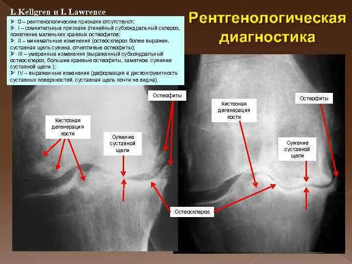 Kellgren-Lawrence классификация остеоартроза. Рентгенологические стадии по Келлгрену. Суставная щель неравномерно сужена.