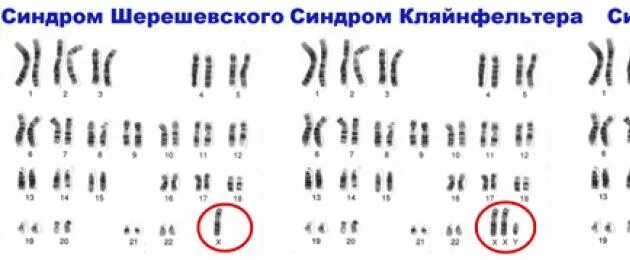 Пересадка хромосом. Кариотип при синдроме кошачьего крика. Кариотип синдрома кошачьего крика формула. Хромосомные заболевания синдром кошачьего крика. Кариотип хромосом при синдроме Шерешевского-Тернера.